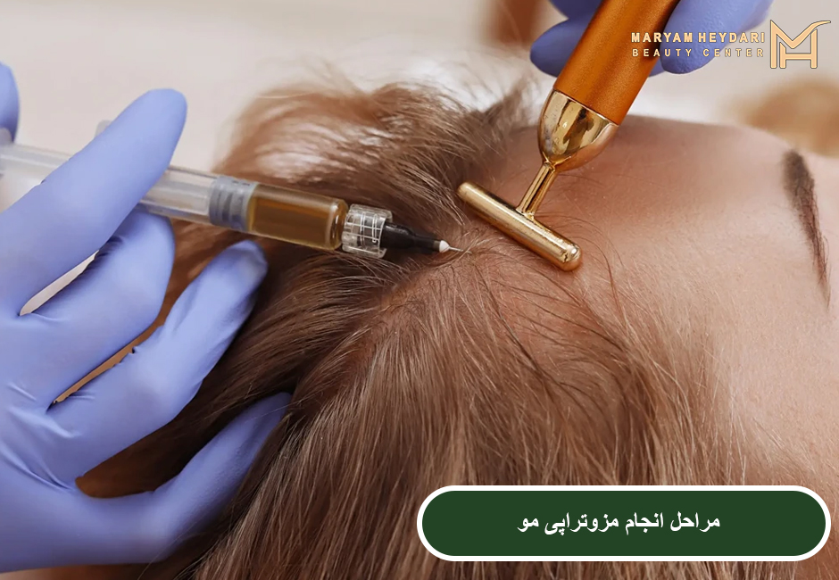 مراحل انجام مزوتراپی مو