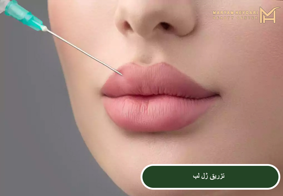 تزریق ژل لب