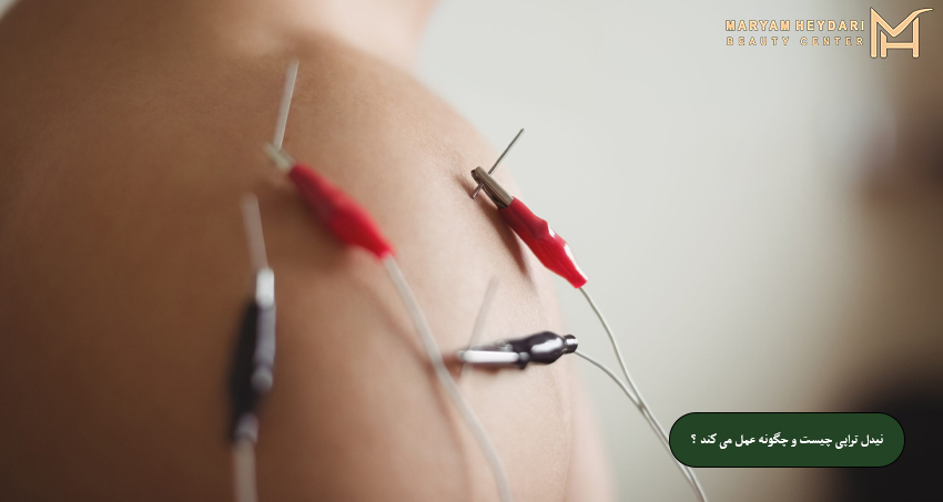 نیدل ‌تراپی چیست و چگونه عمل می‌ کند؟