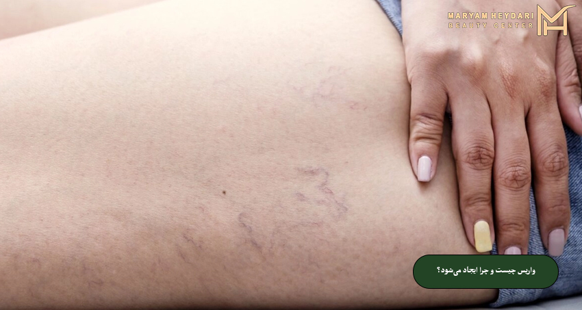 واریس چیست و چرا ایجاد می‌شود؟