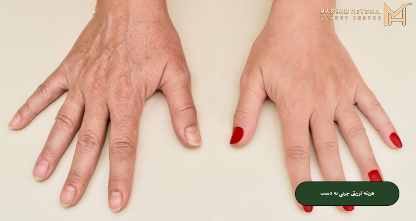 هزینه تزریق چربی